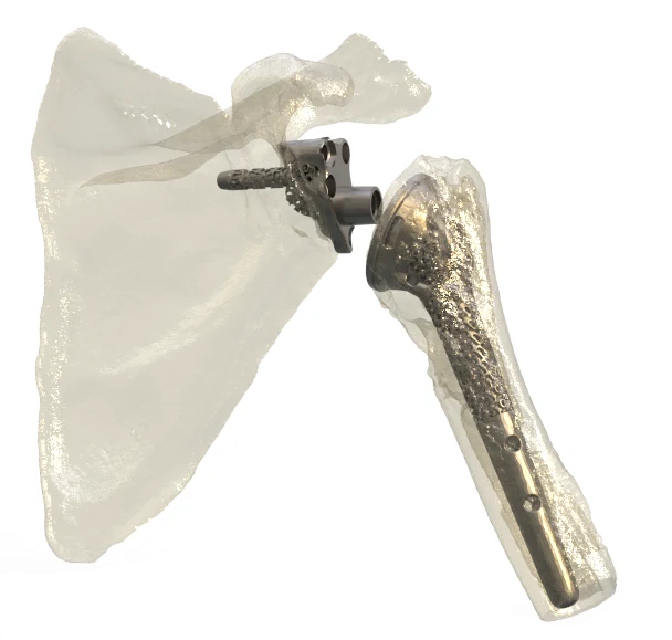 Patient-Specific Shoulder Implant