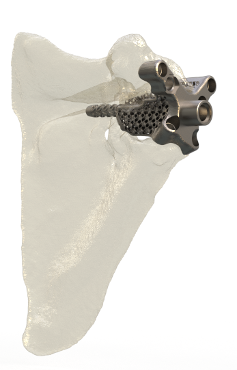 Patient-Specific Implants