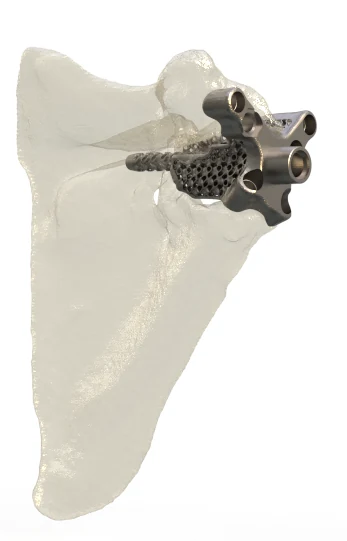 Patient Specific Implants