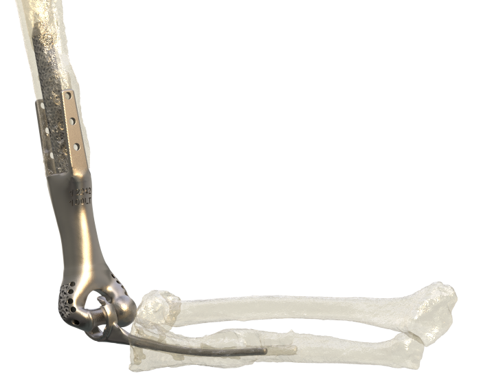 Patient-Specific Elbow Implant