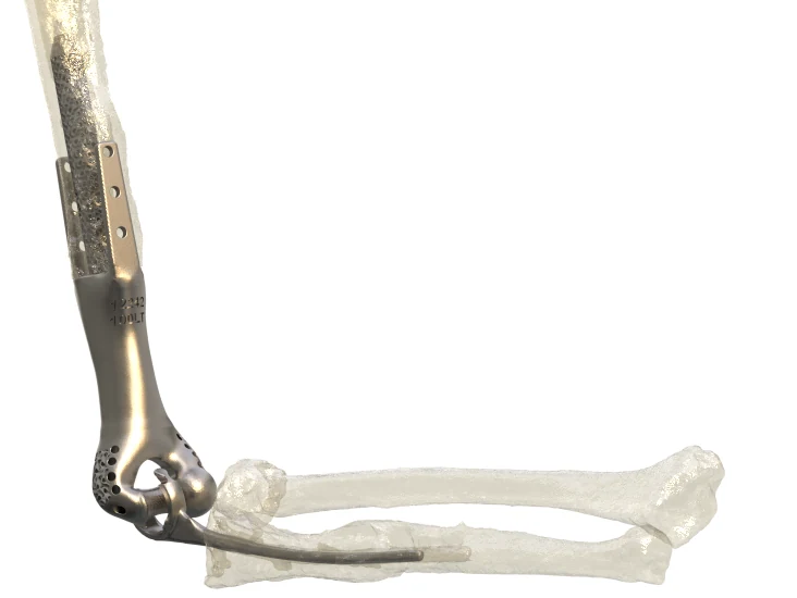Patient-Specific Elbow Implant
